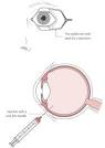 A szemgolyó belsejébe juttatott injekció