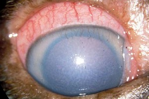 A zöldhályog tünetei: az ínhártya feletti erek megvastagszanak, a szaruhártya homályossá, szürkéssé válik, a pupilla kitágul